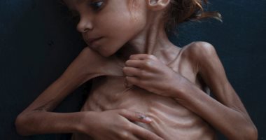 مأساة الطفلة أمل فى اليمن.. تهز ضمير العالم بعدما قتلها "الجوع".. فيديو