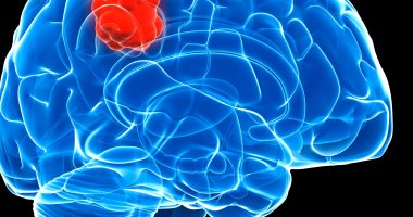 الإزالة المبكرة لأورام الدماغ بطيئة النمو تزيد من عمر المرضى