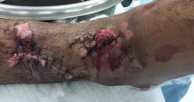 نجاح جراحة تثبيت مؤقت لكسر مضاعف بعظمتي الساق اليمني لمصاب بجنوب سيناء 