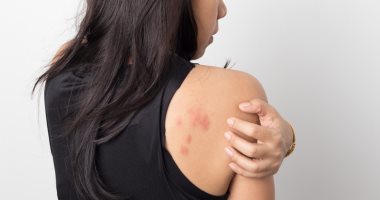 5 أسباب لعدوى مبيضات الجلد.. السمنة وطفح الحفاضات وسوء النظافة الأبرز