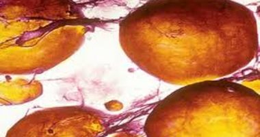 دراسة: فيروس كورونا يمكن أن يصيب الخلايا الدهنية