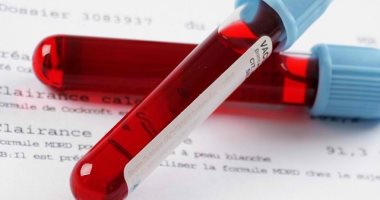 تطوير اختبار دم جديد للكشف عن مرض الزهايمر بشكل أسرع وأرخص وأكثر دقة
