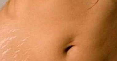 طرق مؤكدة للتخلص من الجلد المترهل وعلامات التمدد بعد الحمل