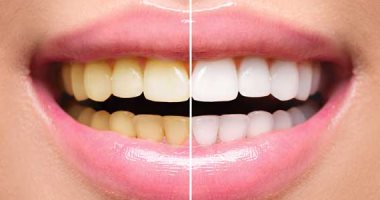 Whitening Sensitive Teeth: Tips and Methods to Brighten Your Smile Safely