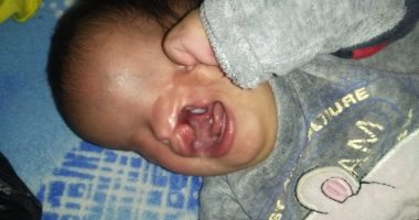 استجابة لـ اليوم السابع.. وزيرة الصحة تأمر بعلاج طفلة مصابة بتشوهات خلقية