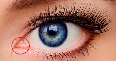  التهاب الملتحمة.. أعراضه وكيفية تأثيره على العين وطرق الوقاية