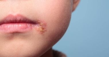 قرح الفم.. 5 علاجات منزلية طبيعية تساعد في الشفاء  