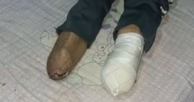 صور.. قارئ يناشد بتركيب طرف صناعى لفقدانه قدميه بعد نجاته من حادث