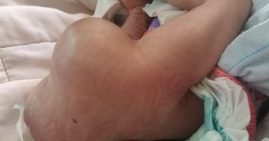 فريق طبى ببنها يستئصل ورما يزن 4 كيلو من جسد طفلة حديثة الولادة