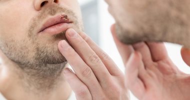 اعراض الهربس أبرزها قروح فى الفم أو الأعضاء التناسلية