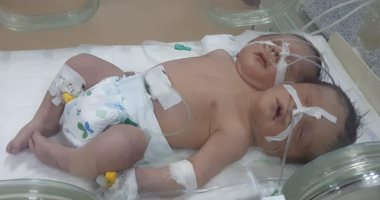 وفاة طفل بـ "رأسين  بعد ولادته بأسبوعين نتيجة هبوط حاد فى الدورة الدموية 