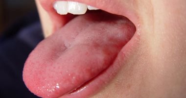 خبراء بريطانيون: التهاب اللسان قد يكون من أعراض فيروس كورونا الأكثر انتشار
