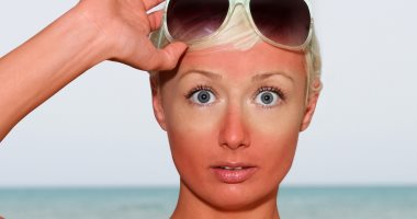 لماذا تحمر بشرتك عند التعرض لحروق الشمس؟