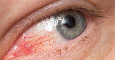 All you need to know about pink eye and is it contagious?