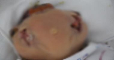 صورة.. ولادة رضيع بأربع عيون وفمين فى سوريا