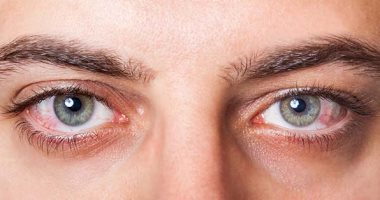 7 إسعافات أولية عاجلة فى حالة تطاير مادة كيميائية داخل العين