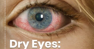 جفاف وحساسية العين أبرز أسباب الاحمرار.. اعرف طرق العلاج
