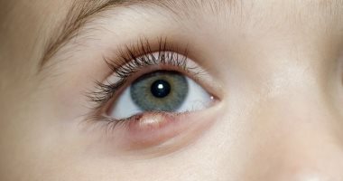 ما هي المدة المتوقعة لشفاء العين نتيجة التهاب القرنية