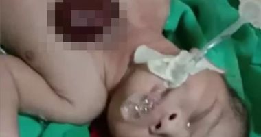 فيديو.. ولادة طفل بالهند بقلب خارج الصدر بسبب مرض نادر  