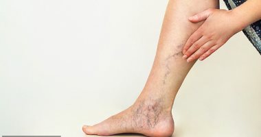 Vascular Professor: Walking daily and avoiding standing too much is the best prevention against varicose veins in the legs