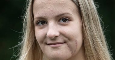 جراحة نادرة لفتاة 15 عاما تعرضت لحادث أدى لكسر بالفك وانفصاله عن الوجه