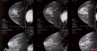 فيديو.. تعرف على إحصائيات "سرطان الثدى" بالدول العربية
