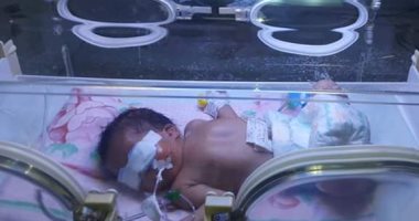 إنقاذ طفلة من الموت بعد ولادتها بأنف مسدودة بالمحلة.. صور