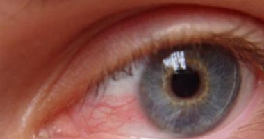 الضمور البصرى مرض خطير يعرضك للعمى.. كيف تحمى نفسك منه؟