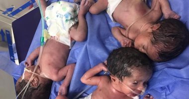 إجراء عملية ولادة طبيعية نادرة بنجاح لسيدة أنجبت 3 توائم بمستشفى أرمنت 