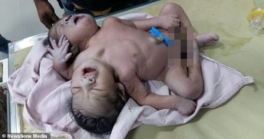 شاهد ولادة طفل برأسين و3 أذرع فى الهند وشكوك حول بقائه على قيد الحياة