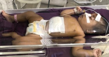 مستشفى الزقازيق العام تجرى جراحة نادرة لطفلة تبلغ 4 أيام وتستبدل مفصل لسيدة