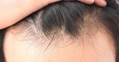 مقاومة الرفع الدقيقة عند الرجال تسبب تساقط الشعر المفرط Sjvbca Org