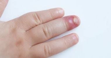 الداحس التهاب يصيب الأصابع.. اعرف أنواعه وأسبابه 
