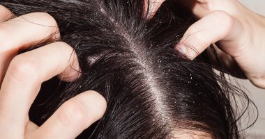 5 أسباب طبية لتساقط الشعر عند الأطفال