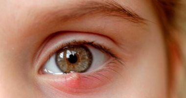 علاج دمل العين بطرق عديدة منها الكمادات الساخنة