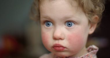 صفع الخد.. مرض يصيب الأطفال يسبب احمرار الخدود