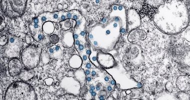 صورة مجهرية تكشف كيف غزت جسيمات كورونا الفتاكة خلايا المريض الأمريكي صفر  