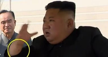 خبير أمريكى عن ندبة على معصم زعيم كوريا الشمالية: قد تكون لعملية بالقلب