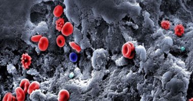 ما الذي يسبب الجلطات الدموية لمرضى الفيروس التاجى؟