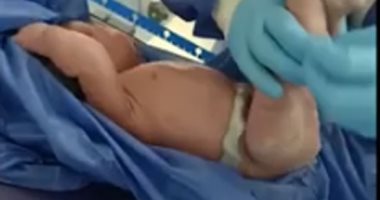 إجراء ولادة قيصرية مبكرة لسيدة مصابة بكورونا بمستشفى المحلة العام