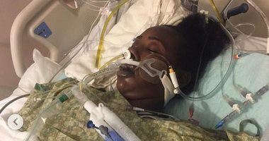 صور.. جراحة نادرة لفتاة أمريكية أنقذت حياتها جعلتها تعيش بالأمعاء خارج البطن