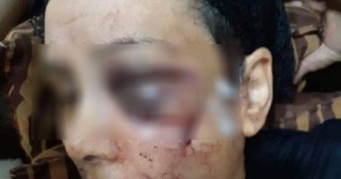والدة الابن العاق بدمياط: ضربنى وكسر ضلوعى بخشبة وأجريت 14 غرزة فى عينى