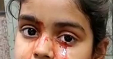 فتاه هندية تبكى بدل الدموع "دم" فى حالة طبية نادرة