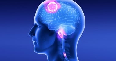 ورم المخ.. أعراض قد تظهر في المراحل الأخيرة من المرض