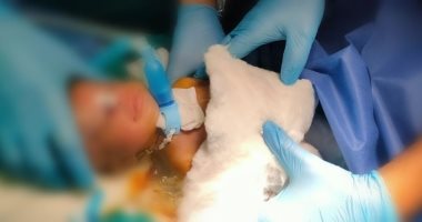 إجراء عملية جراحة شق حنجرى لطفل عمره 54 يومًا لأول مرة بالسويس