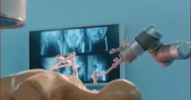 تقنية صينية فائقة.. ابتكار روبوت طبى لإجراء جراحات العمود الفقرى "فيديو"