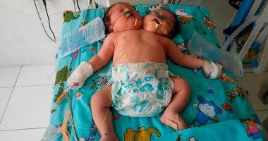  وفاة توأمين ملتصقين بفارق 3 ساعات فى أوزبكستان بعد 9 أيام من ولادتهما