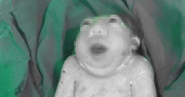 صور صادمة لولادة طفل يعانى من تشوهات خلقية فى العراق