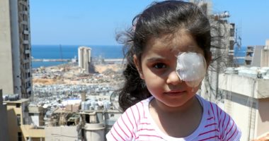 قصة طفلة سورية فقدت عينيها في انفجار بيروت بعد احتفالها بعيد ميلادها السادس