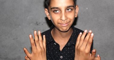 صبى بـ12 إصبعاً فى الهند يؤكد سعادته لتفوقه فى الألعاب ويرفض الجراحة.. صور